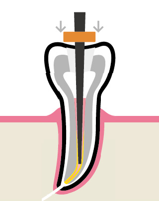 Вертикальная конденсация - этап 2 удаления излишков